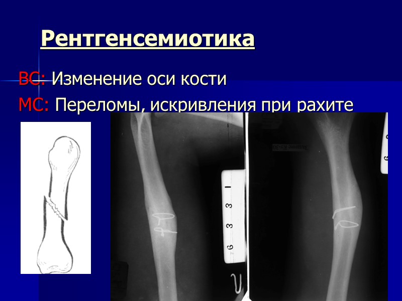 Рентгенсемиотика ВС: Изменение оси кости МС: Переломы, искривления при рахите